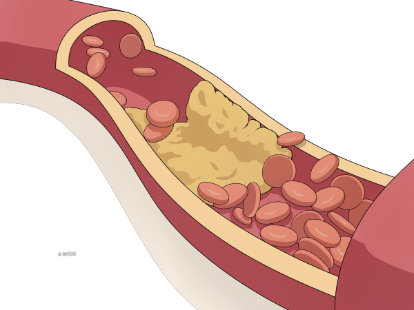 心梗丧命,竟是他汀惹的祸?常年吃他汀的患者,要牢记“三查两忌”