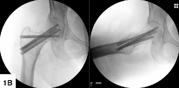 股骨颈骨折选空心钉、交叉全螺纹钉与FNS怎么选?看原理及证据