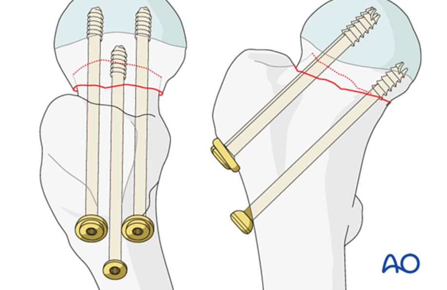 股骨颈骨折选空心钉、交叉全螺纹钉与FNS怎么选?看原理及证据