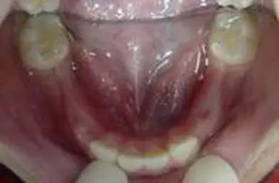 各种间隙保持器赏析