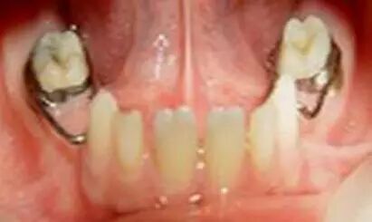 各种间隙保持器赏析