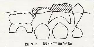 各种间隙保持器赏析