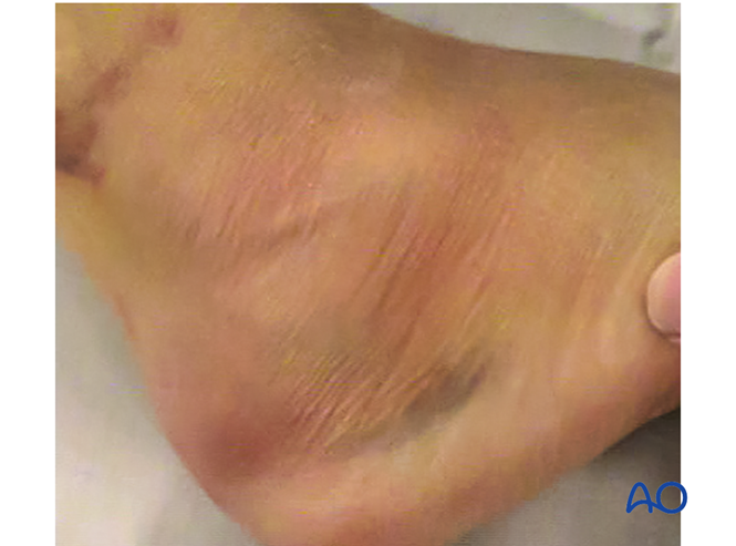 跟骨的跗骨窦入路（AO官网版）