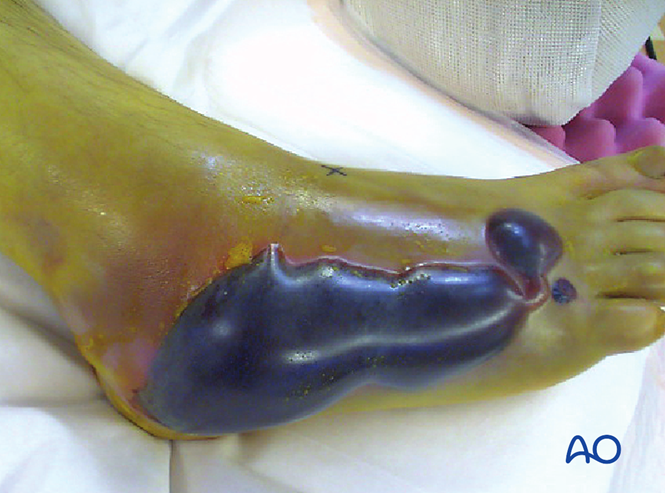 跟骨的跗骨窦入路（AO官网版）