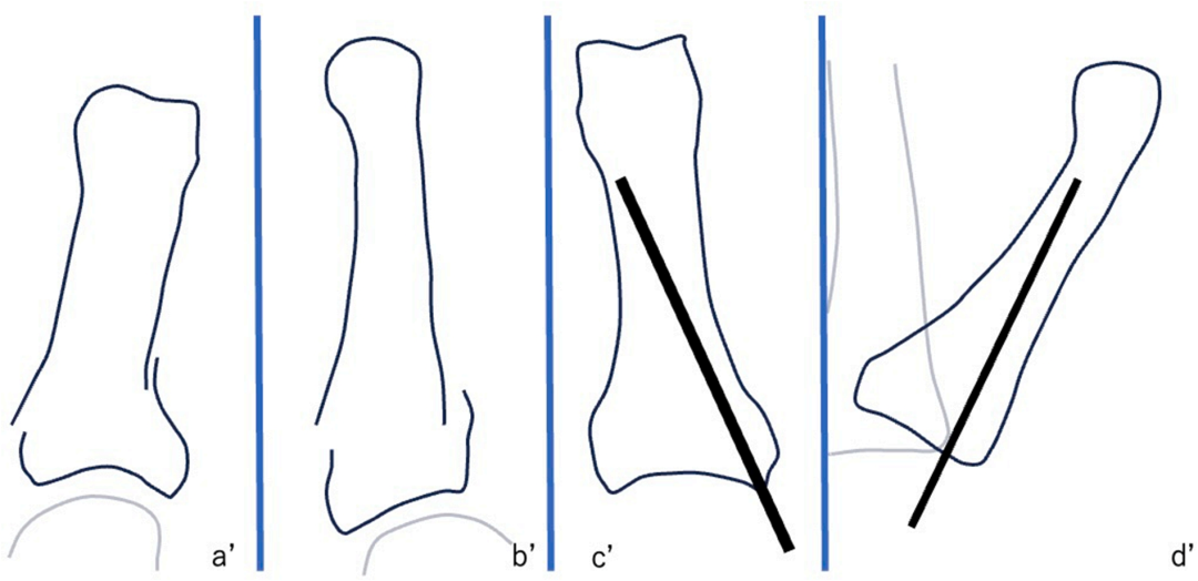 避开软骨与肌腱:日本专家创新斜置螺钉技术(oblique