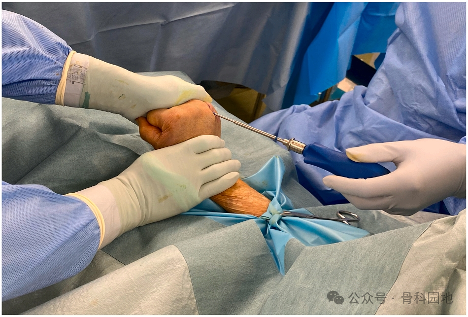 避开软骨与肌腱:日本专家创新斜置螺钉技术(oblique