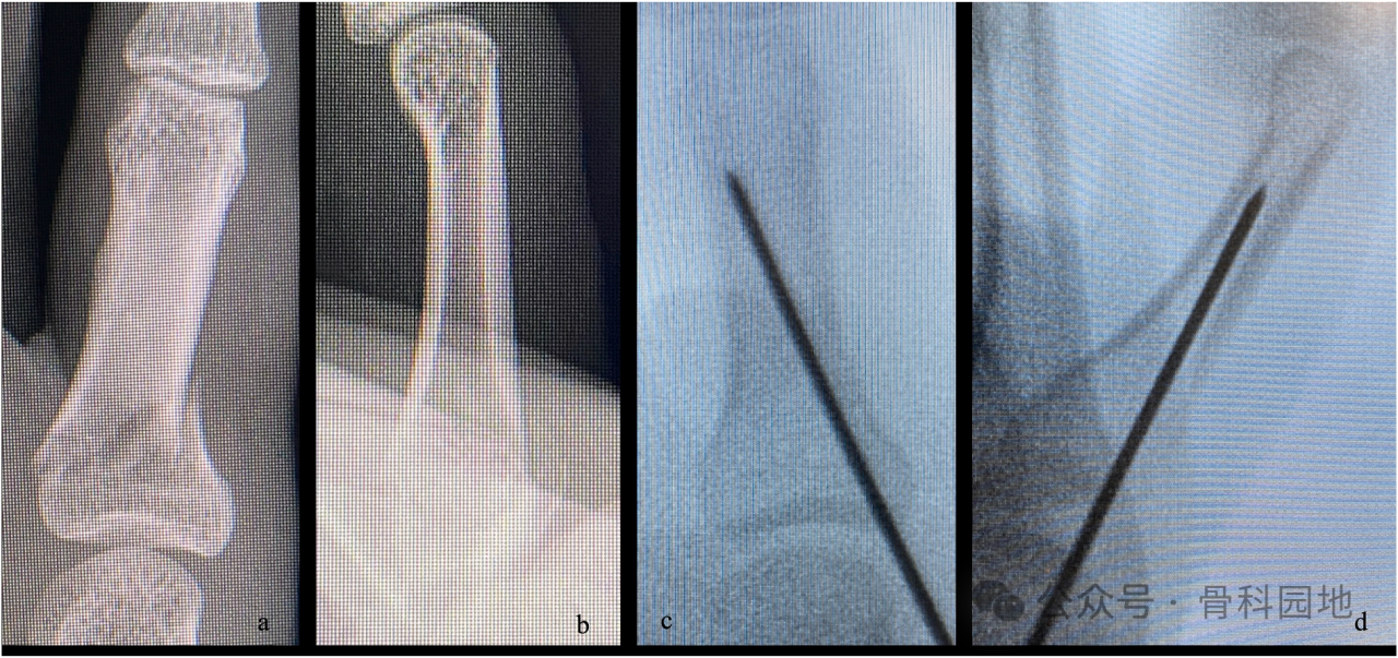 避开软骨与肌腱:日本专家创新斜置螺钉技术(oblique