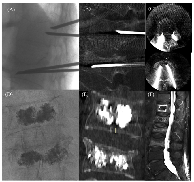 经皮椎体成形术步骤、技巧和注意事项：来自20篇论文的总结