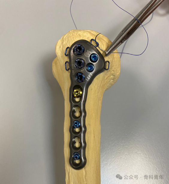 手术技巧 | 低切迹钢板联合“钉中钉技术”固定肱骨近端骨折 - 好医术文章 - 好医术-赋能医生守护生命
