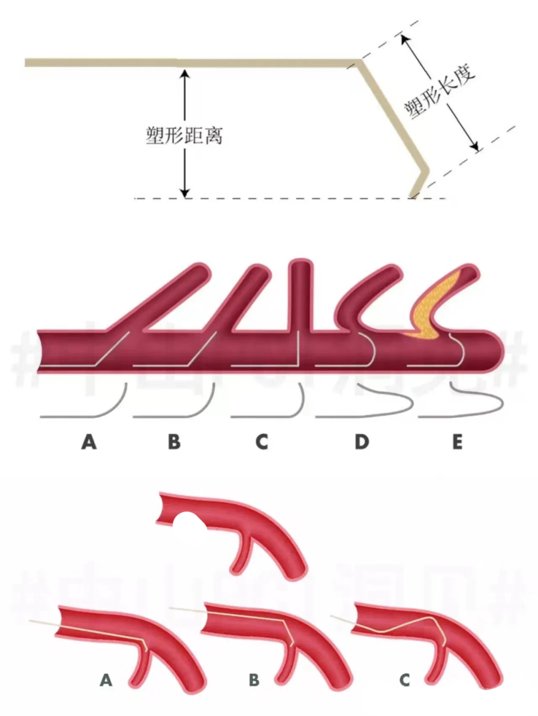 介入技术：导丝的基本操作