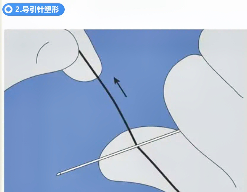 介入技术：导丝的基本操作