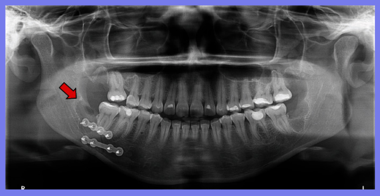 智齿拔除，术中意外发生下颌骨骨折