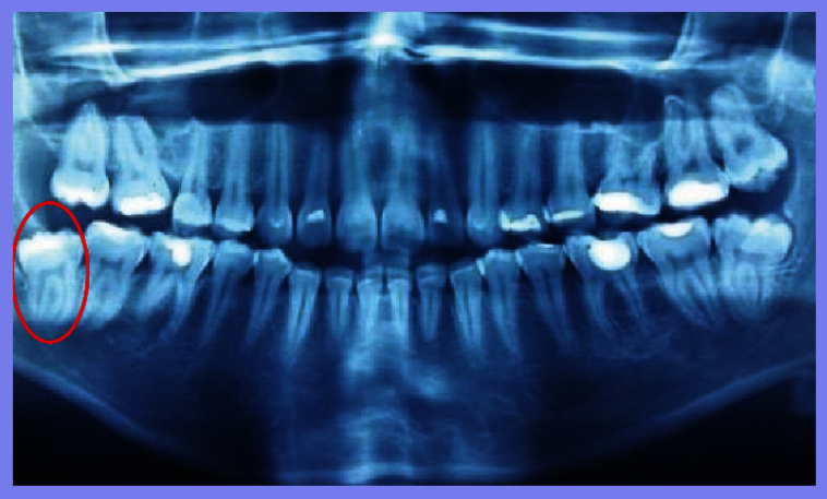 智齿拔除，术中意外发生下颌骨骨折