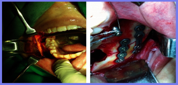 智齿拔除，术中意外发生下颌骨骨折