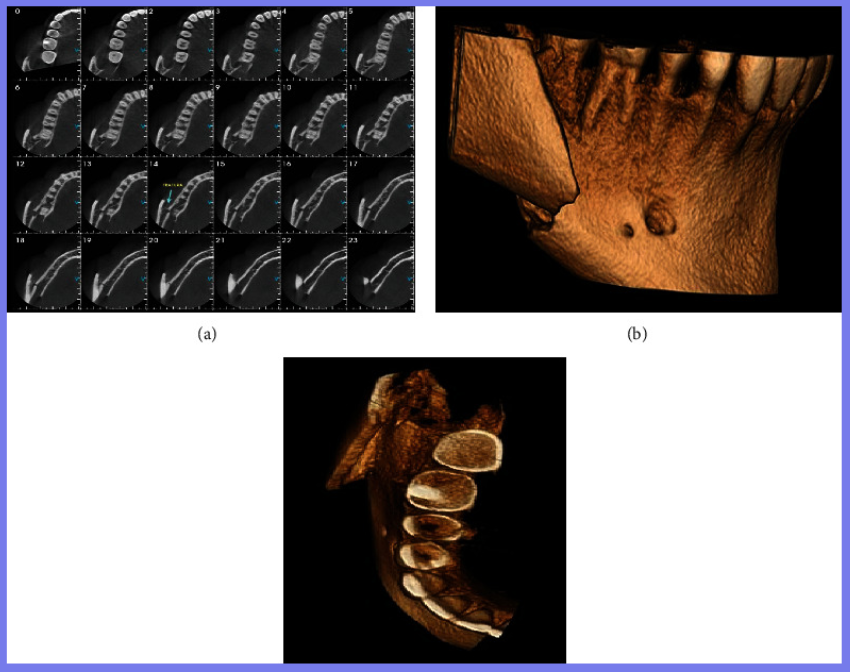 智齿拔除，术中意外发生下颌骨骨折