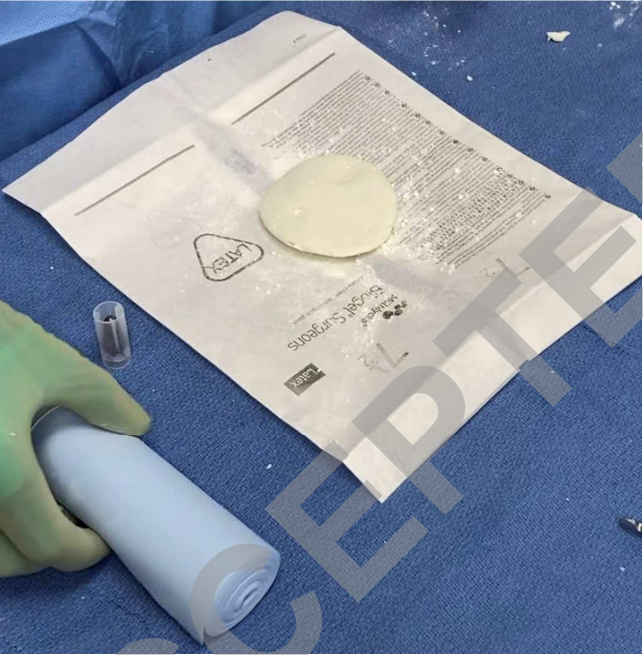 抗生素骨水泥链珠：一种最大化水泥珠表面积与体积比以提高抗生素洗脱率的技术技巧