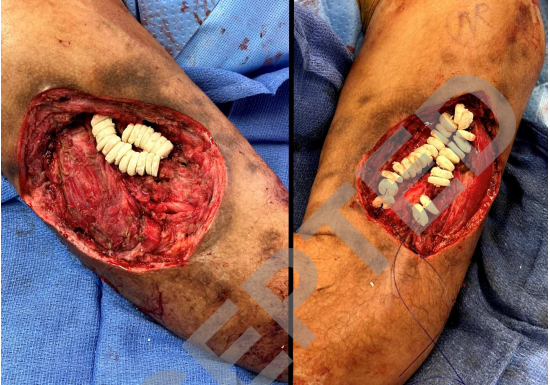 抗生素骨水泥链珠：一种最大化水泥珠表面积与体积比以提高抗生素洗脱率的技术技巧