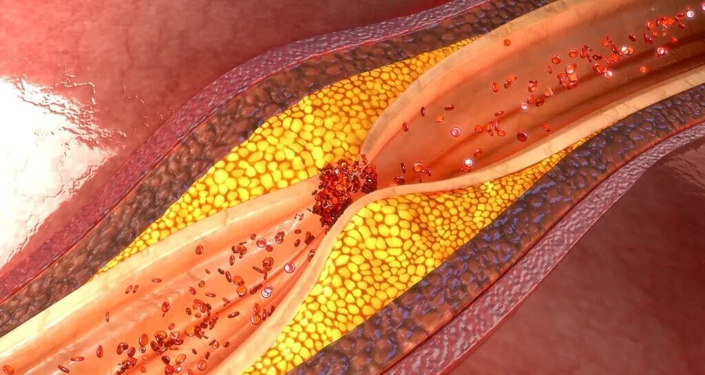 吃他汀类药物的时候，一定要搭配阿司匹林吗？注意不要过度治疗