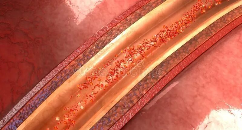 吃他汀类药物的时候，一定要搭配阿司匹林吗？注意不要过度治疗