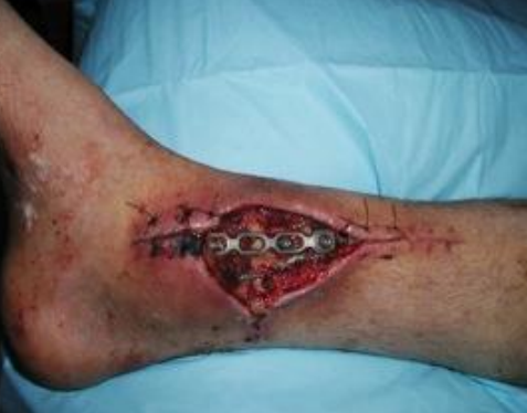 骨折相关感染生物标志物,哪些内植物可保留?