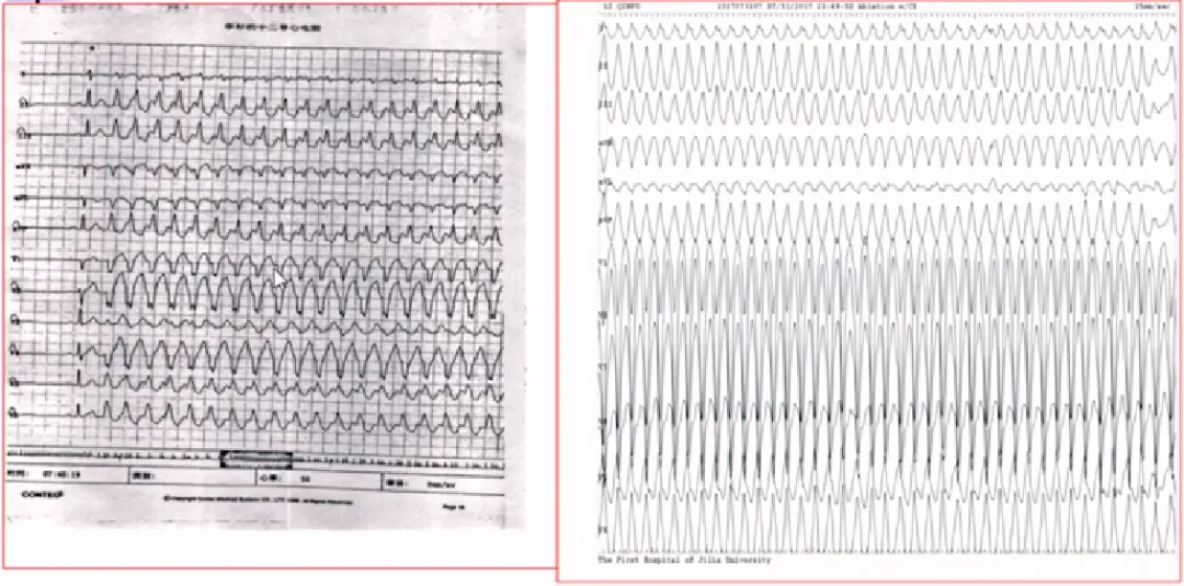 心律解码丨房颤合并差传和预激综合征心电图鉴别