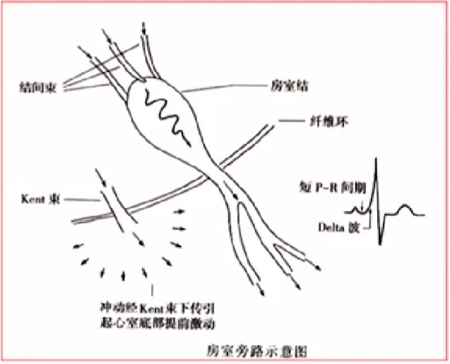 心律解码丨房颤合并差传和预激综合征心电图鉴别
