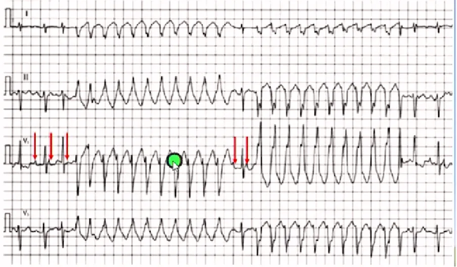 心律解码丨房颤合并差传和预激综合征心电图鉴别