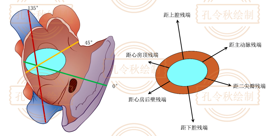 房间隔缺损大小,到底如何测量? - 好医术文章 - 好医术-赋能医生守护生命