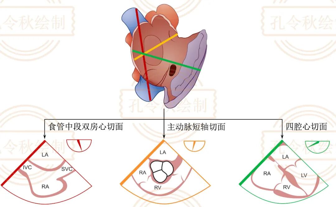 房间隔缺损大小,到底如何测量? - 好医术文章 - 好医术-赋能医生守护生命