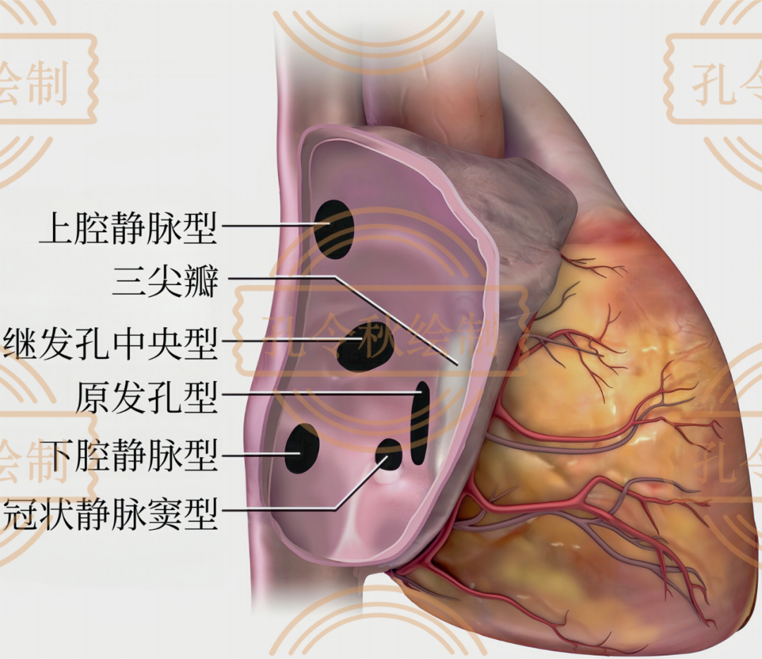 房间隔缺损大小,到底如何测量? - 好医术文章 - 好医术-赋能医生守护生命