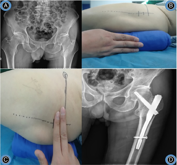 “三指法”辅助PFNA治疗股骨转子间骨折