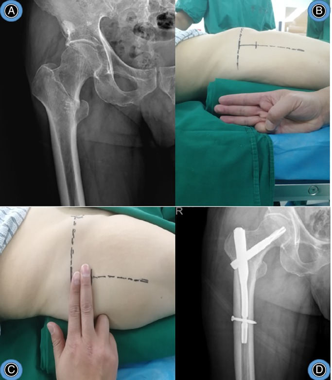 “三指法”辅助PFNA治疗股骨转子间骨折