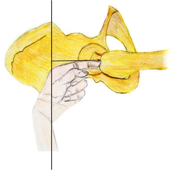 “三指法”辅助PFNA治疗股骨转子间骨折