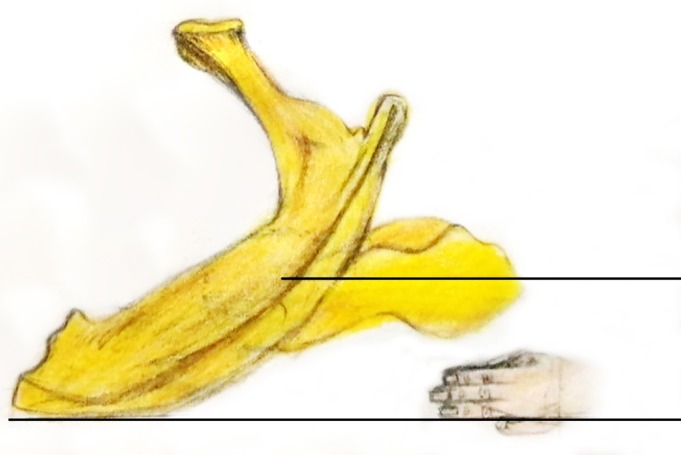 “三指法”辅助PFNA治疗股骨转子间骨折