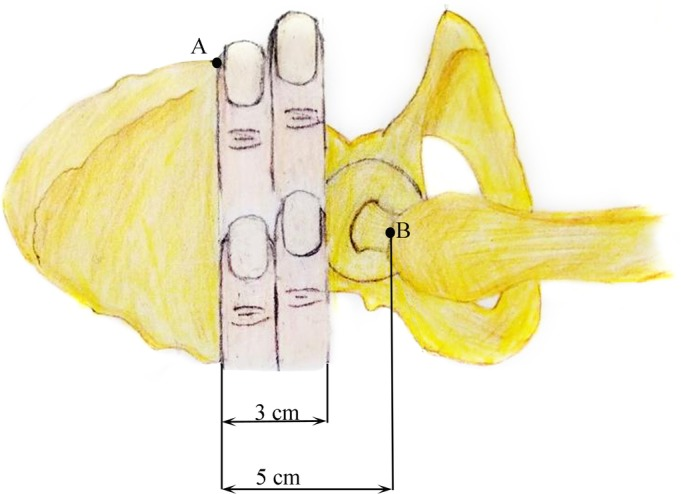 “三指法”辅助PFNA治疗股骨转子间骨折