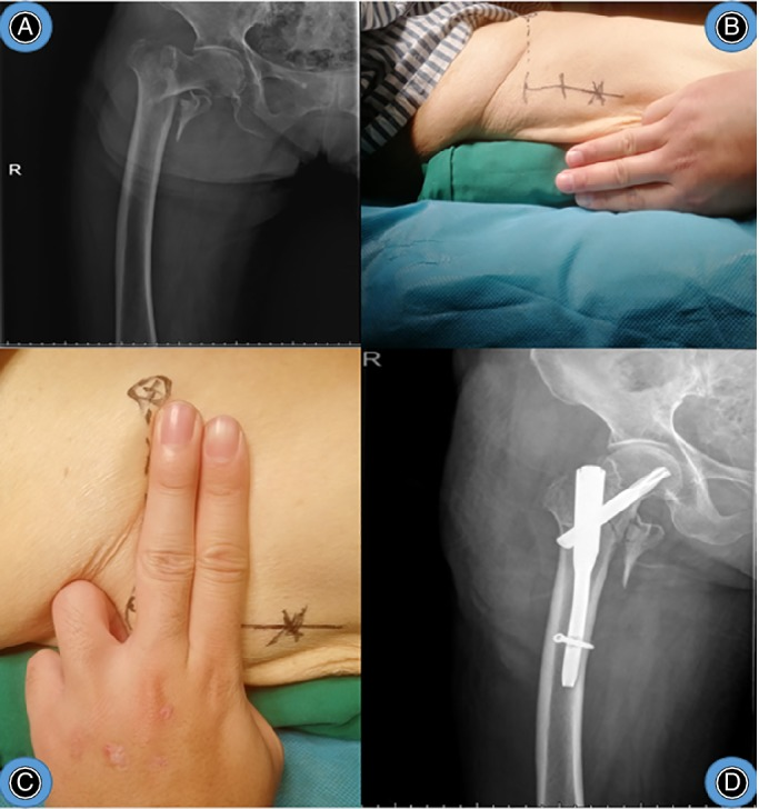 “三指法”辅助PFNA治疗股骨转子间骨折