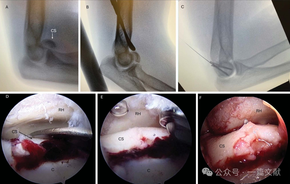 JAAOS:5种肘关节骨折内固定手术入路,100%干货!