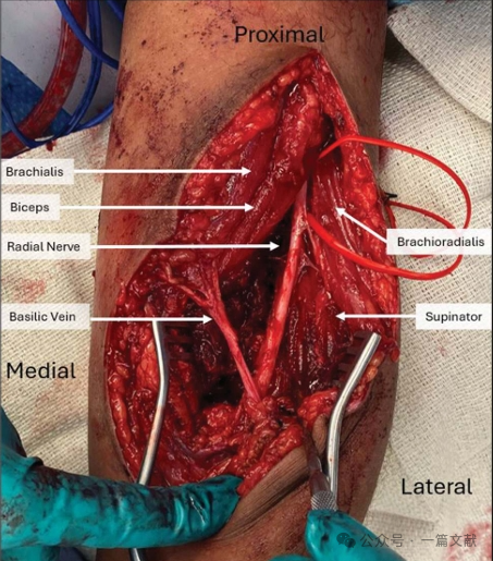 JAAOS:5种肘关节骨折内固定手术入路,100%干货!