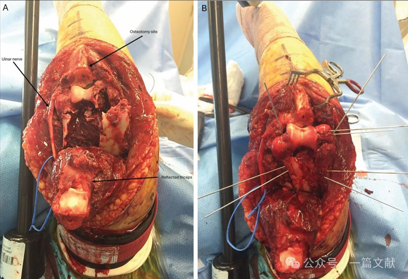 JAAOS:5种肘关节骨折内固定手术入路,100%干货!