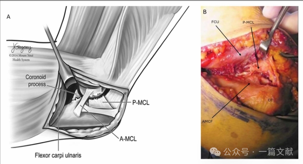 JAAOS:5种肘关节骨折内固定手术入路,100%干货!