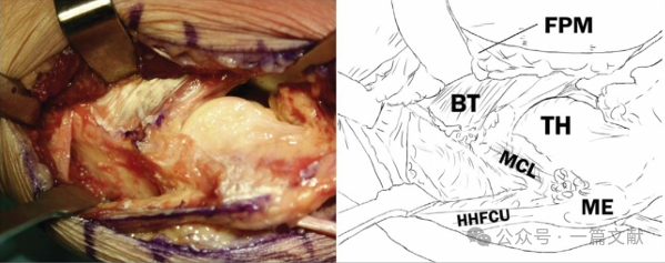 JAAOS:5种肘关节骨折内固定手术入路,100%干货!