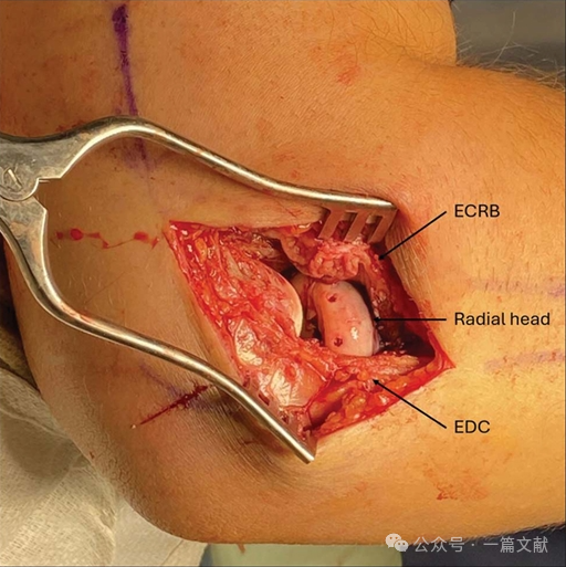 JAAOS:5种肘关节骨折内固定手术入路,100%干货!