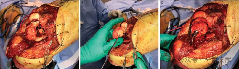 JAAOS:5种肘关节骨折内固定手术入路,100%干货!