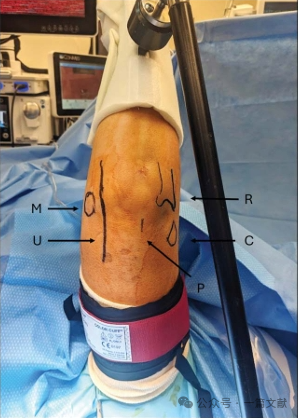 JAAOS:5种肘关节骨折内固定手术入路,100%干货!