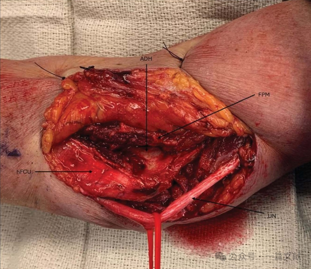 JAAOS:5种肘关节骨折内固定手术入路,100%干货!