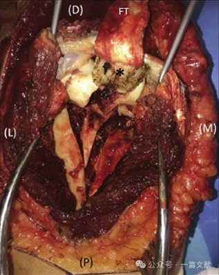JAAOS:5种肘关节骨折内固定手术入路,100%干货!