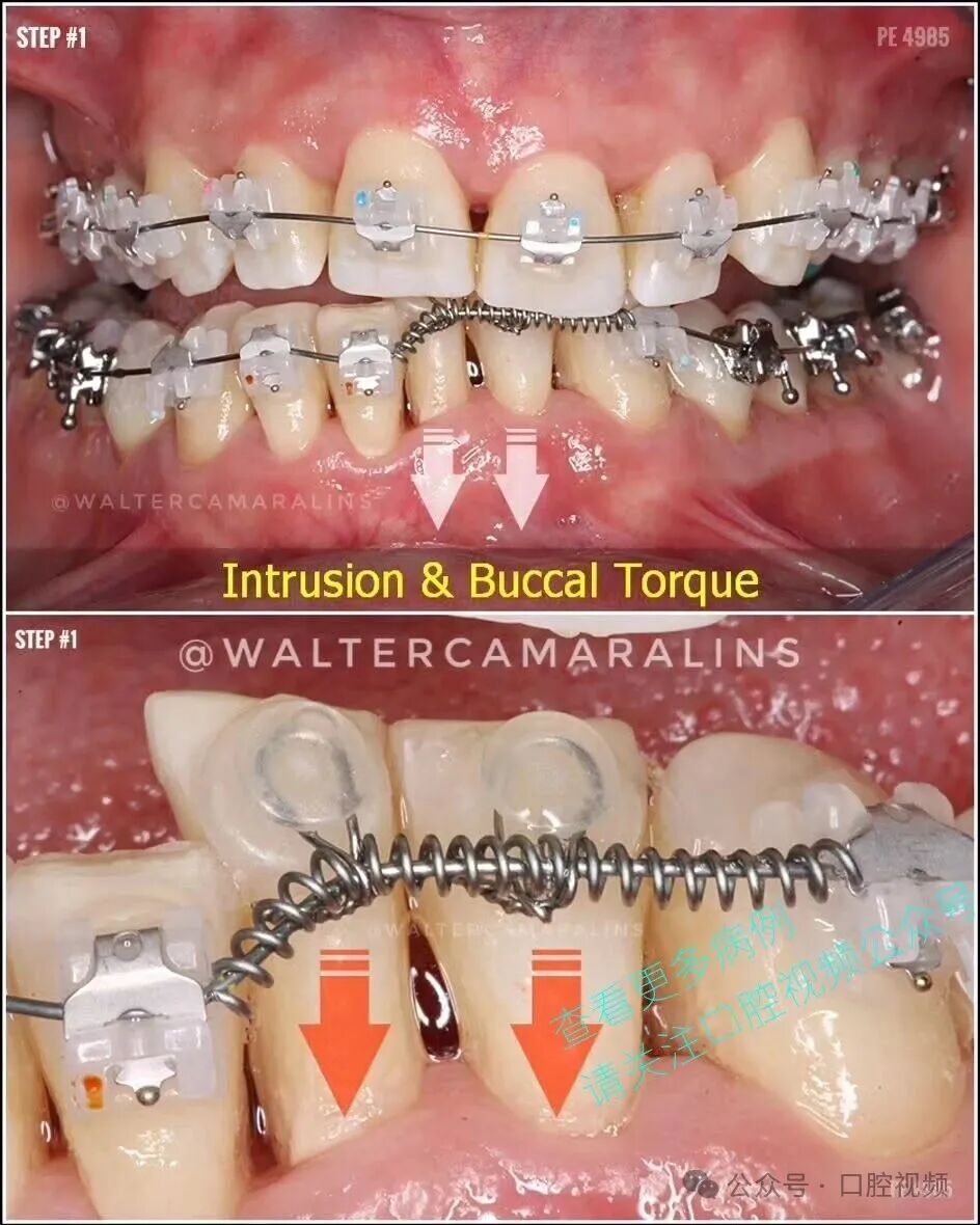 这样的正畸,该怎么收费
