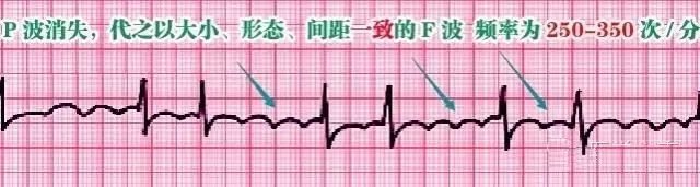 教你心电图，没有理由看不懂！