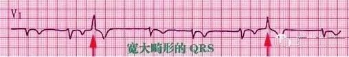 教你心电图，没有理由看不懂！