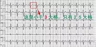 教你心电图，没有理由看不懂！